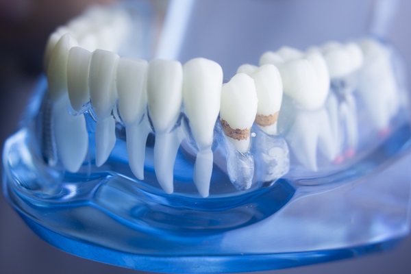 Why Gum Disease Prevention Is So Important
